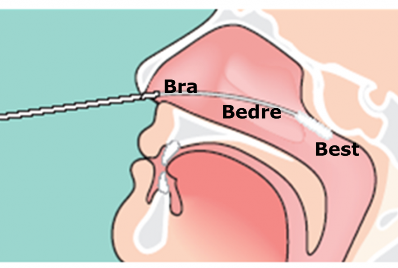 illustrasjon av koronatesting med tverrsnitt av hodet som viser nesekanalene med en lang testpinne opp i nesa og bak i halsen